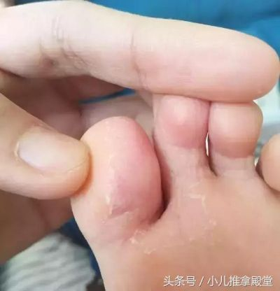 脚上怎样分辨是脚气还是湿疹（女性脚气初期图片）